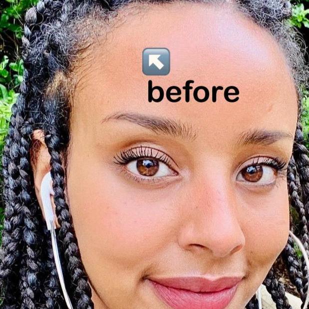 Derma Roller for Scalp Growth