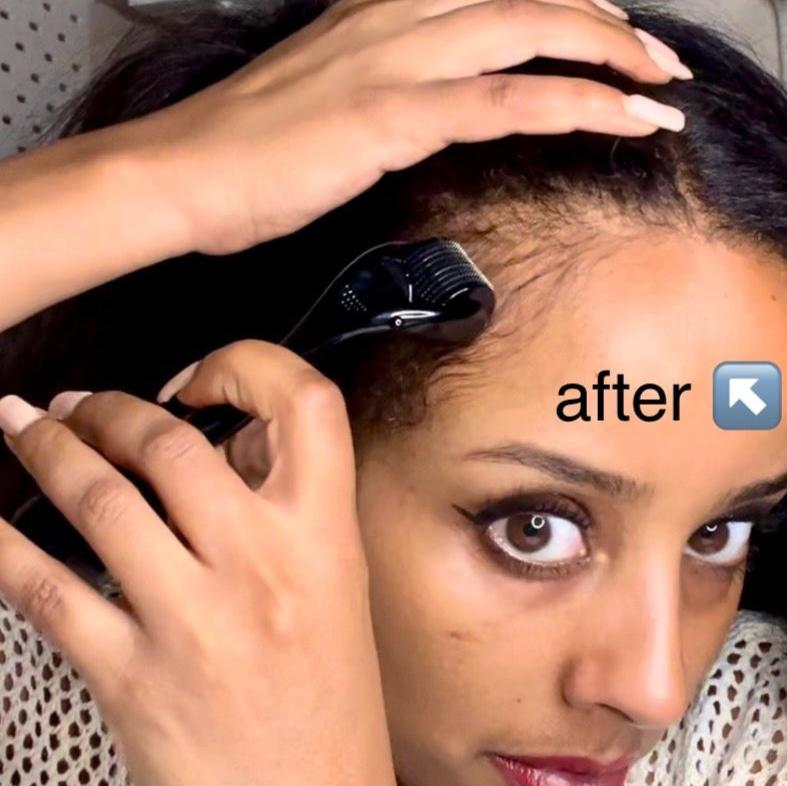 Derma Roller for Scalp Growth